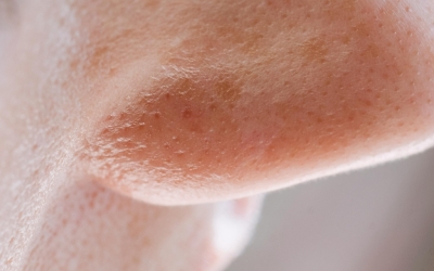 Comment enlever les points noirs ? Toutes les astuces pour une peau nette 